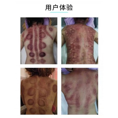 蓝精灵智能养生仪刮痧经络疏通温热拔罐仪图5