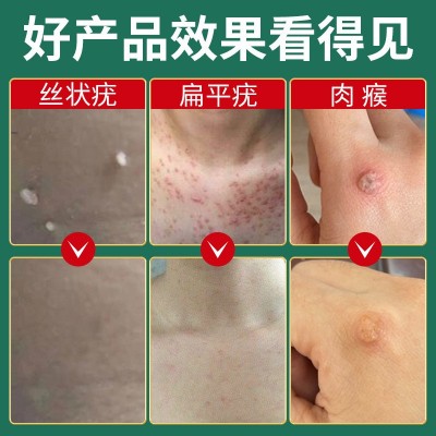 采芝林清疣液体敷料脖子肉粒疣体手指脚趾尖锐疣丝状克疣液现货图3
